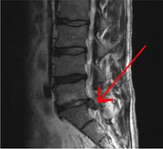 Image result for Low Back Imaging