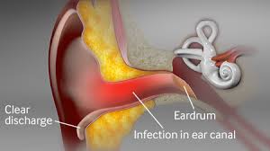 Image result for Acute Otitis Externa