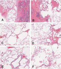 At least once a year in cf patients. Emphysema Is Common In Lungs Of Cystic Fibrosis Lung Transplantation Patients A Histopathological And Computed Tomography Study