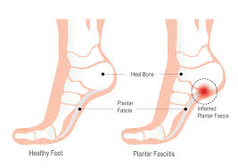 Image result for Foot Pain