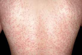 Pityriasis rosea is associated with reactivation of herpesviruses 6 and 7, which cause the primary rash roseola in infants. Pityriasis Rosea Nhs