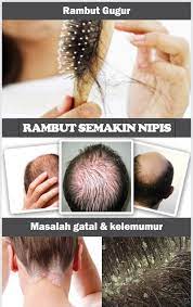 Untuk mengatasi rambut gugur, lumur minyak kelapa ke rambut hingga mengenai seluruh kulit kepala. Merawat Masalah Rambut Gugur Hans