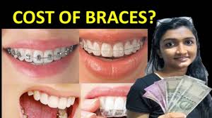 What is the average cost of teeth braces? Cost Of Braces In India Dental Braces Ceramic Braces Metal Braces Clear Aligners Lingual Braces Youtube