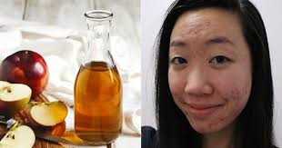 Dùng thử toner giấm táo trị mụn “thần thánh” cô nàng này đã rút ra kết luận  đau thương