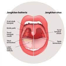 Cara menghilangkan jerawat dengan menggunakan lidah buaya untuk menghilangkan jerawat adalah kerok gel lidah buaya secara langsung dengan menggunakan sendok. Menangani Sakit Tekak Anak Anda Positive Parenting