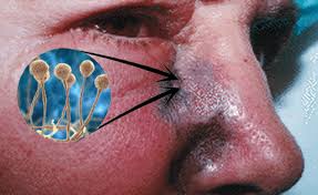 Qué es el hongo negro: Actualidad Luego Que La Secretaria Campus Television Facebook