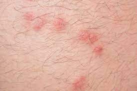 You need to learn how to detect fleas in your house. What Do Flea Bites Look Like Terminix