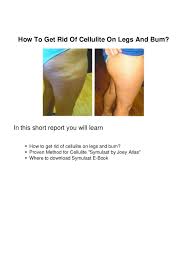 It is infrequent to find swelling and pain in the affected area. How To Get Rid Of Cellulite On Legs And Bum