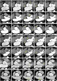 Data displayed on monitor = * info stored in the pixel related to attenuation = ct numbers * everything. Improving Low Dose Cardiac Ct Images Based On 3d Sparse Representation Scientific Reports