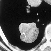 It is one of the most common benign tumors of the lung and accounts for ~8% of all lung neoplasms and 6% of solitary pulmonary nodules. Lungenrundherde Pdf Free Download