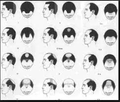 Anagen, catagen, telogen and exogen. 19 Hairlosstreatmentsreview Ideas Hair Loss Hair Loss Treatments Help Hair Loss