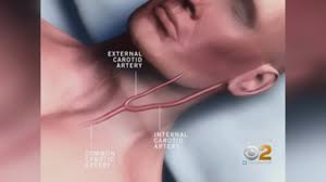 Having been a victim of a hickey, you may be seeking payback. How To Get Rid Of A Hickey Fast As Humanly Possible Yourtango