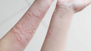 Image result for Papular urticaria