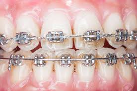 How to avoid staining your clear braces. Close Up Orthodontics Teeth With Stains Stock Photo Picture And Royalty Free Image Image 40689868