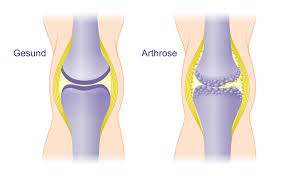 Arthrose Gelenkerhaltende Therapie Gelenk Klinik De