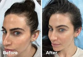 Alma TED Hair Treatment Review and Photos