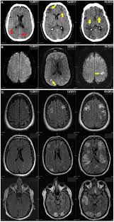 Image result for Brain Lesion