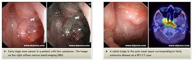 The stage of a cancer tells the doctor how far it has grown and if it has spread. Dr Jeeve Ent Singapore Head And Neck Cancer Surgeon