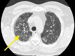 Auscultation of the lungs adventitious (added) sounds three types of adventitious a soft friction rub in early dry pleurisy may be mistaken for crepitation or fine bubbling rales but is not altered by coughing as rales; Cureus Idiopathic Pulmonary Fibrosis A Case Of Mistaken Identity