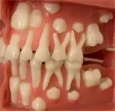 If you have a shark tooth that's flat and in the shape of a wide triangle, then you may have a white shark tooth on your hands. I M 18 And I Still Have All My Baby Teeth What Should I Do Quora