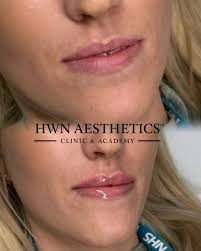 Natural. Defined. Undetectable. 😍 We LOVE Lips that look like yours but  enhanced. Our signature technique blends height, volume, and precision to  harmonise with your facial structure. Once healed, your lips soften