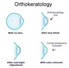 Maybe you would like to learn more about one of these? Fully Customized Orthokeratology Ortho K Treatment For Children Aerov Pte Ltd Singapore