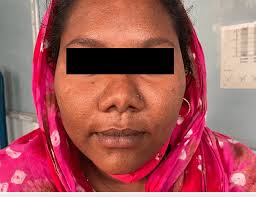 Clinical picture of mother with features of virilsation in form of acne.