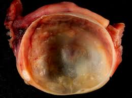 Polycystic ovary syndrome (pcos) is generally characterized by the presence of polycystic ovaries, hyperandrogenism (the condition caused by excess these cysts are not tumors and do not require removal. Ovarian Cyst Wikipedia