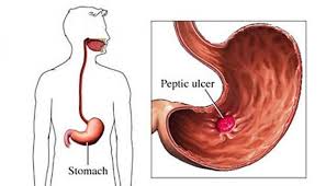 Pin On Prilosec No More