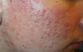 How to get rid of papules. Acne Types In Pictures Explanations And Treatments
