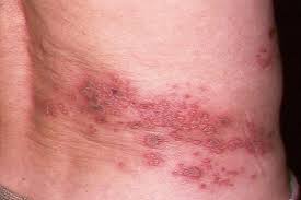 Adakah cara menghilangkan parut chicken pox ini? Ain On Twitter Khairul Hafidz Assalam Doktor Sy Ade Soalan Chicken Pox Tu Betul Ke Skali Seumur Hidup Je Kena Dan Kalau Dah Dewasa Pun Masih Kena Juga Ke