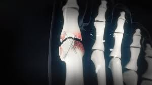 Hallux Rigidus Wenn Jeder Schritt Zur Qual Wird Gesundheit Br Fernsehen Fernsehen Br De