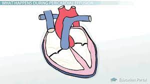 • inflammation is a defensive process that a living body initiates against local tissue damage. Pericardial Effusion Causes Symptoms And Treatment