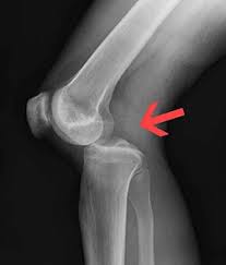 Image result for Knee XRay
