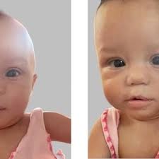 Shows a significant improvement of the facial muscles' functionality on... 