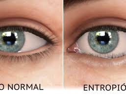 Que Es Un Chalazion Y Como Se Cura