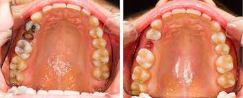 Tooth Extraction Orion S Dental