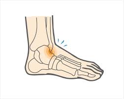 The pain can occur as a result of muscle strain as well contusion. Ankle Impingement Anterior Upswing Health