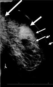 The usual cause of inflammatory breast symptoms is breast mastitis or duct ectasia. Inflammatory Breast Cancer The Disease The Biology The Treatment Robertson 2010 Ca A Cancer Journal For Clinicians Wiley Online Library