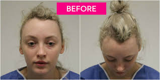 These hairstyles for thinning hair are sizzling hot & make you the envy of every woman you know. Ballerina Loses Her Hair To Traction Alopecia Due To Tight Bun Gets Follicular Transplant
