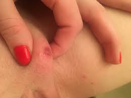 Basically, what causes any type of ingrown hair anywhere on the body: Ingrown Hair Pictures Includes Glow Community