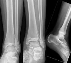 Image result for Growth Plate