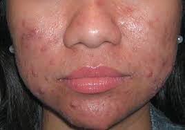 Acne and Rosacea: Epidemiology, Diagnosis and Treatment