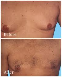 Image result for Gynecomastia
