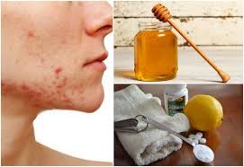 6 Hausmittel Gegen Zystische Akne Besser Gesund Leben