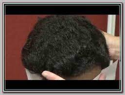 For Decades Has Worried Just About Her Thinning Hair Learning About Androgenetic Alopecia Has Helped Hair Loss Women Hair Transplant Women Frontal Hair Loss