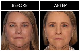 Image result for Laser Skin Procedure