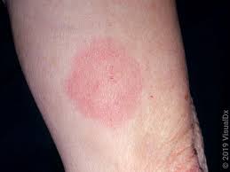 Image result for infected tick bite