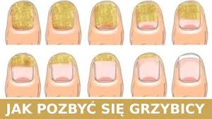 Jak Pozbyc Sie Grzybicy Szybko I Naturalnie Youtube