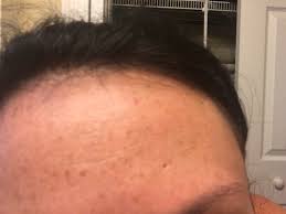100 % t a t t o o e d 🙌🏻 for my client. I Ve Had This Hole In The Skin Of My Forehead For Years Photo